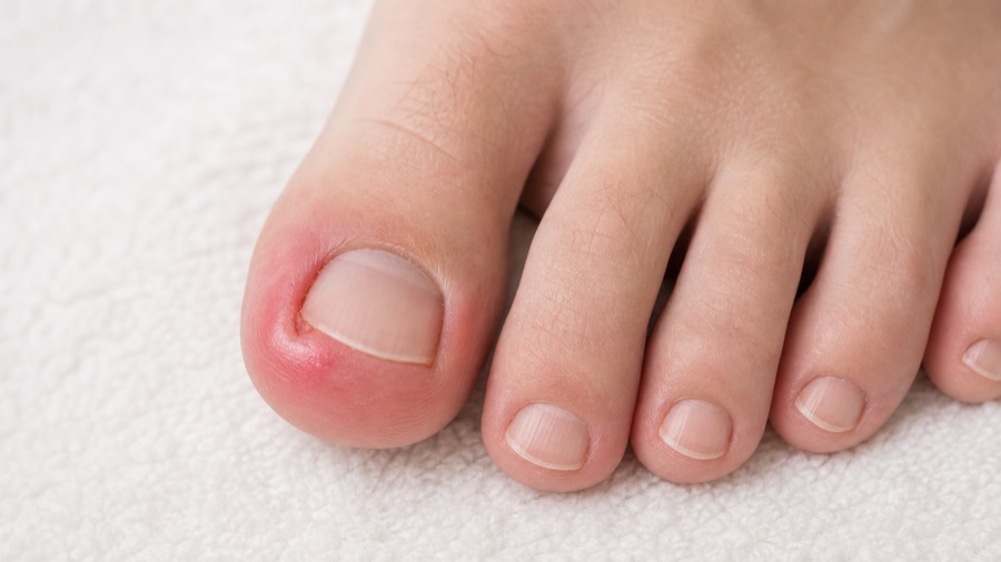Ingrown Toenails